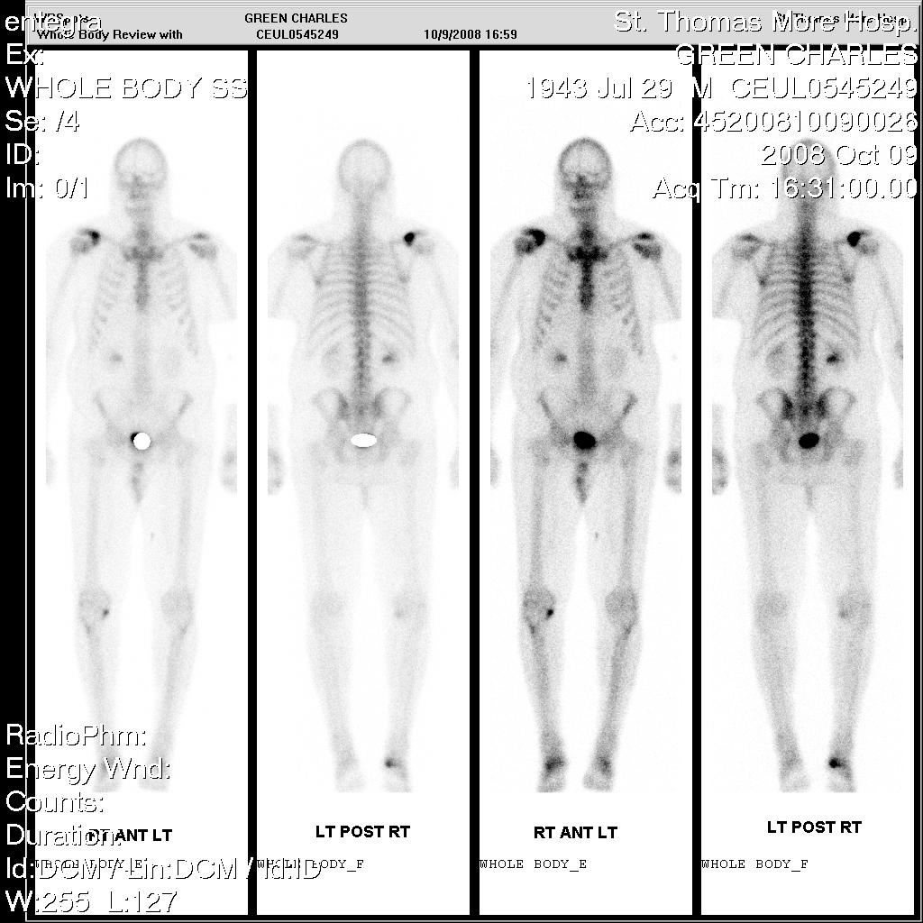 What are normal and abnormal bone scan results?